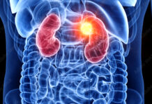 Camouflaging as a dead enzyme VEGFR1 holds key to medical solutions for colon and renal cancers